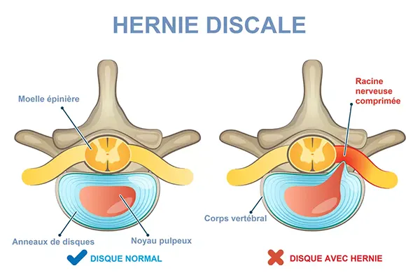 Comment Soigner Une Hernie Discale Naturellement