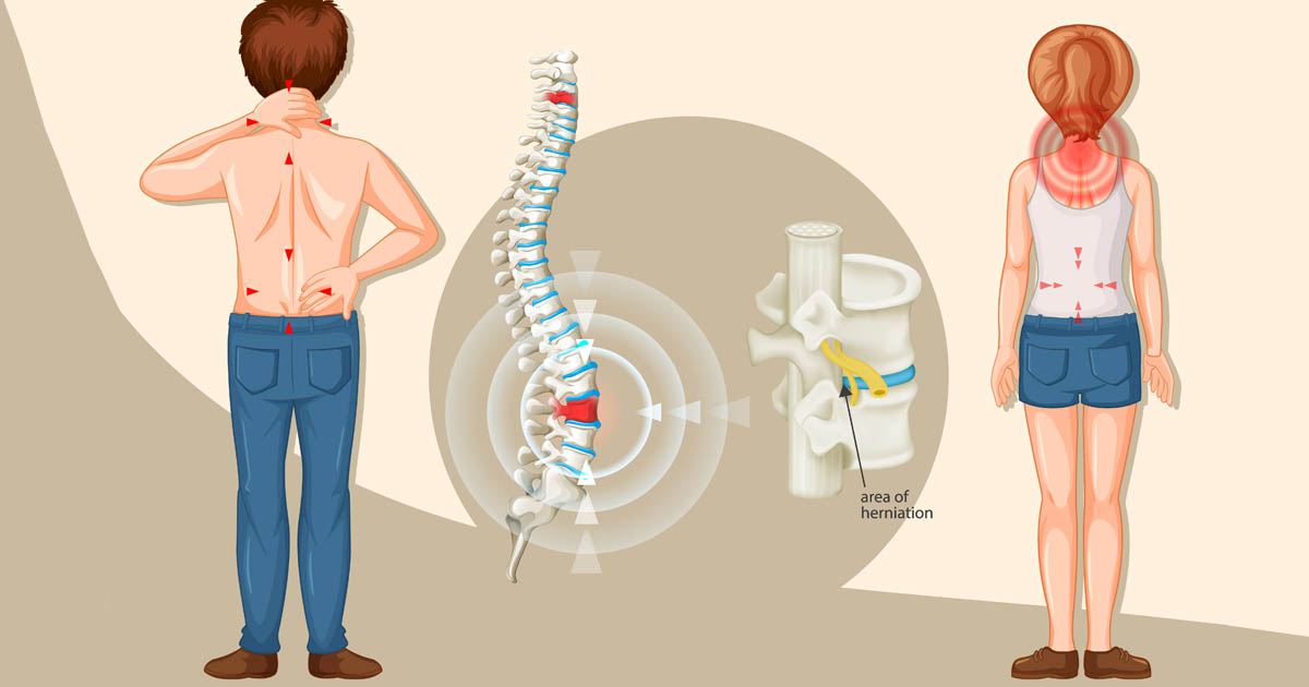 Comment Soigner Une Hernie Discale Naturellement